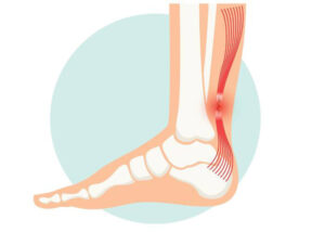 Achilles Tendon Improvement | Ankle doctor