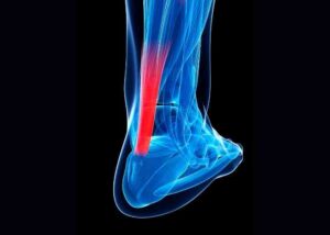 Achilles Tear Tear or Rupture | Ankle specialist